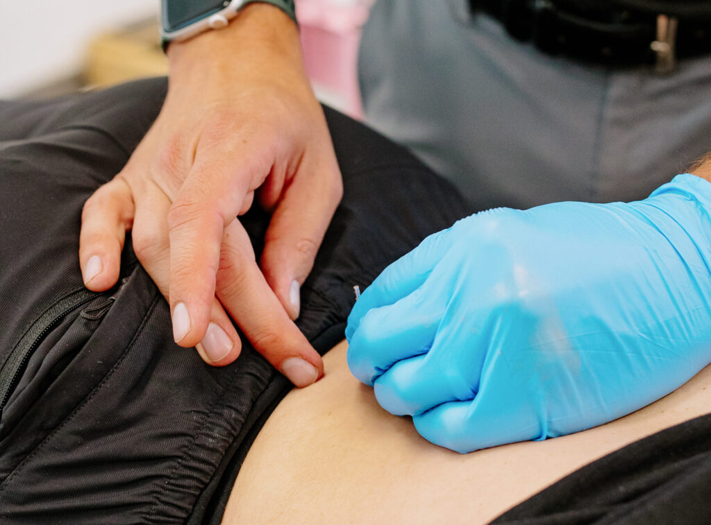 Dry needling being done at The Swift Institute