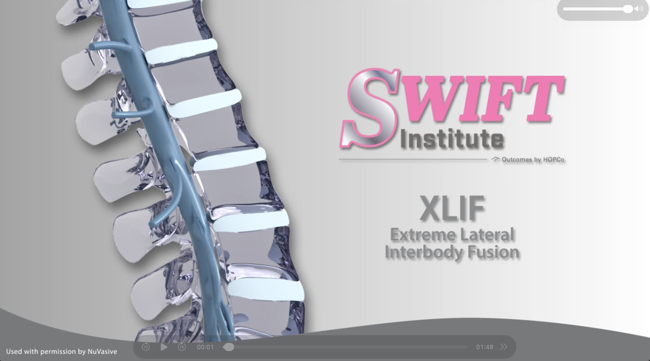 XLIF - Extreme Lateral Interbody Fusion