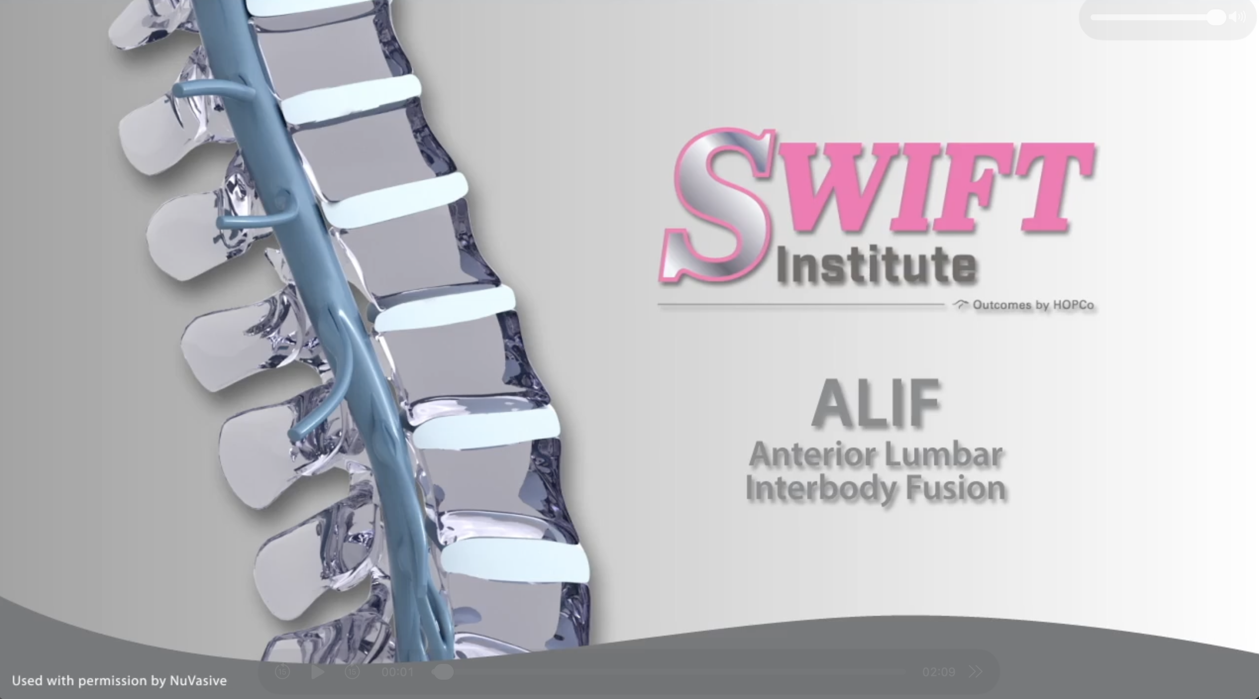 ALIF - Anterior Lumbar Interbody Fusion