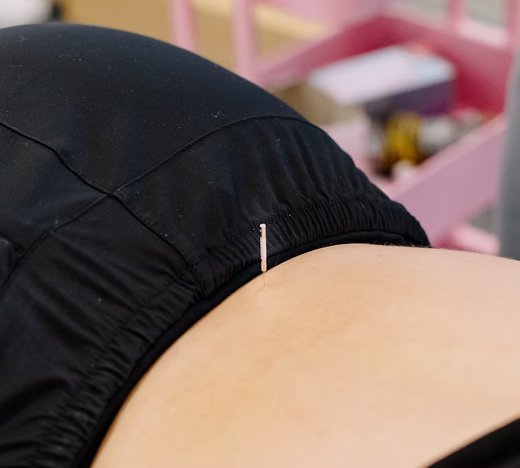 Dry needling being done at The Swift Institute
